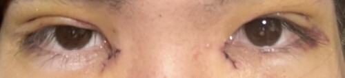 二重切開 明らかに奥二重です 目 二重整形 二重切開法 の治療への不安 痛み 失敗 副作用