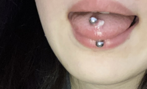 舌ピの周りに白い出来物ができました ピアス穴あけ ボディピアス の治療への不安 痛み 失敗 副作用