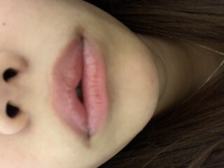 唇ヒアルロン酸注入の失敗？  口元・唇の整形(ヒアルロン酸注入（口元 