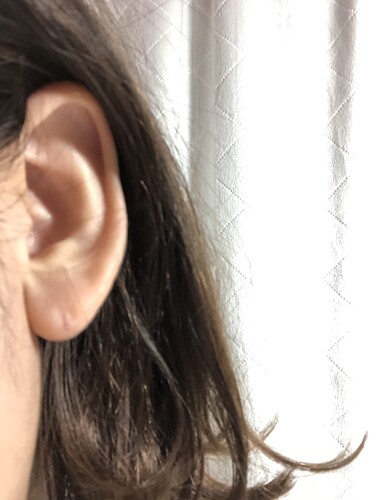 ピアスホールが塞がり 貫通しないので同じ箇所に穴を開けたい ピアス穴あけ 耳のピアス の治療方法 適応