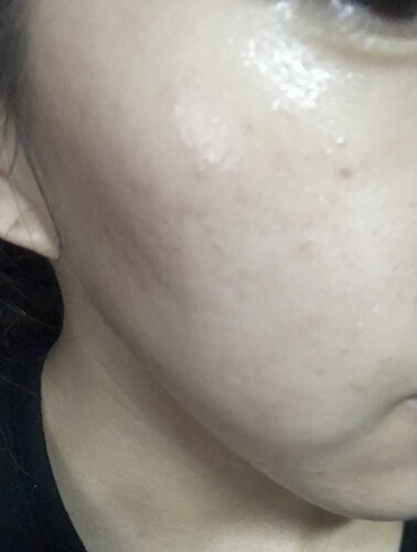 Microdermabrasionによって肌にクレーターが ニキビ ニキビ跡の治療 ケミカルピーリング の治療方法 適応