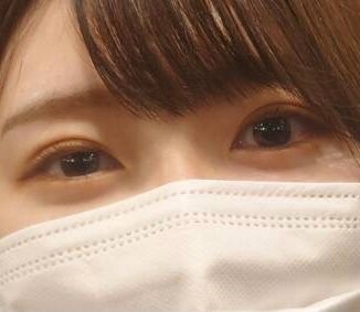 埋没 ハム目相談 目 二重整形の治療への不安 痛み 失敗 副作用