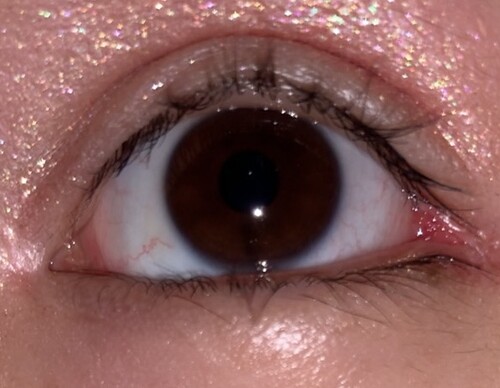 目尻切開後の傷口 目 二重整形 目頭切開 目尻切開 の治療方法 適応