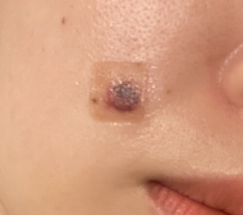 Qスイッチヤグレーザー後の内出血 当日だから酷く見えるだけでしょうか シミ取り 肝斑 毛穴治療 Qスイッチレーザー の治療への不安 痛み 失敗 副作用