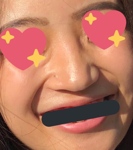 笑った時の線の改善方法 顔のしわ たるみの整形の治療方法 適応