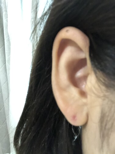 ピアスホールが塞がり 貫通しないので同じ箇所に穴を開けたい ピアス穴あけ 耳のピアス の治療方法 適応