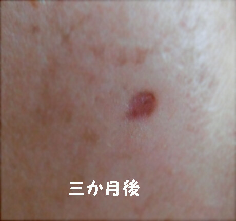 ホクロ除去後の窪みについて ほくろ除去 あざ治療 イボ治療 ほくろのレーザー治療 の治療への不安 痛み 失敗 副作用