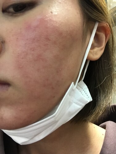 ヴェルヴェットスキン後にアトピーのような肌 シミ取り 肝斑 毛穴治療の治療への不安 痛み 失敗 副作用 ヴェルヴェットスキン後にアトピーのような肌 シミ取り 肝斑 毛穴治療の治療への不安 痛み 失敗 副作用