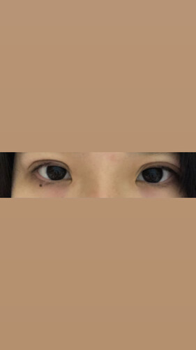 左右の幅が同じになるのか心配です 目 二重整形 二重埋没法 の治療への不安 痛み 失敗 副作用