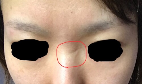 ケミカルピーリング