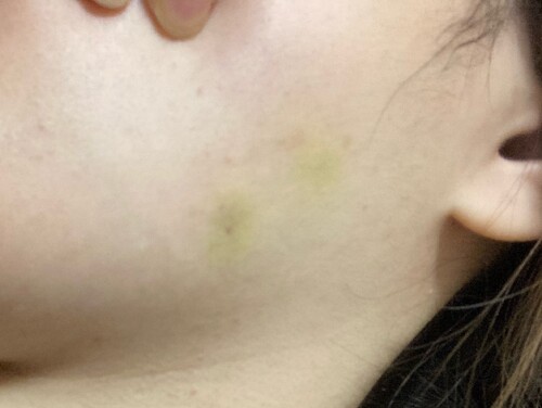 ボトックス内出血痛みの原因 輪郭 顎 エラ 額 小顔整形の治療への不安 痛み 失敗 副作用