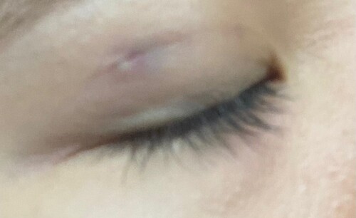 埋没後の瞼に白い出来物 目やにの様なものが 目 二重整形 二重埋没法 の治療への不安 痛み 失敗 副作用
