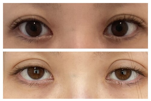 埋没手術による眼瞼下垂について 目 二重整形 二重埋没法 の治療への不安 痛み 失敗 副作用