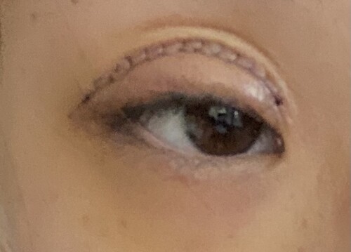 二重全切開 食い込みが浅く三重になっています 目 二重整形 二重切開法 の治療への不安 痛み 失敗 副作用