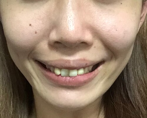 頬 口元のシワ 顔のしわ たるみの整形の治療方法 適応