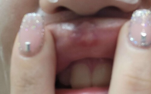 唇ヒアルロン酸注入後の白いデキモノ 口元 唇の整形 人中短縮 ヒアルロン酸注入 口元 唇 の治療への不安 痛み 失敗 副作用