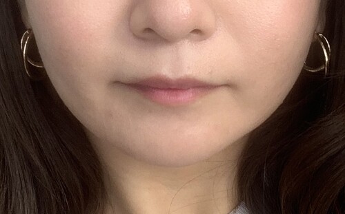 顎ヒアルロン酸でフェイスラインが凸凹 輪郭 顎の整形 ヒアルロン酸注入 輪郭 顎 の治療への不安 痛み 失敗 副作用