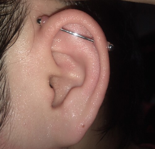 インダストリアルの上部の肉芽 ピアス穴あけの治療への不安 痛み 失敗 副作用