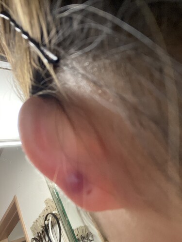 赤紫 の腫れについて 皮膚科に行った方がいいのでしょうか ピアス穴あけ 耳のピアス の治療への不安 痛み 失敗 副作用