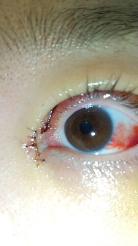 眼瞼下垂術後と目頭の白いぷよぷよ 目 二重整形 眼瞼下垂 の治療への不安 痛み 失敗 副作用