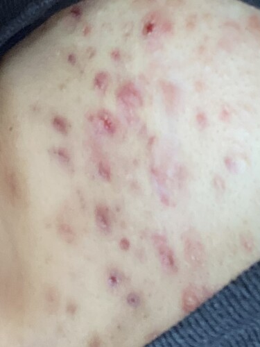 ケロイドか肥厚性瘢痕か ニキビ・ニキビ跡の治療の治療方法・適応