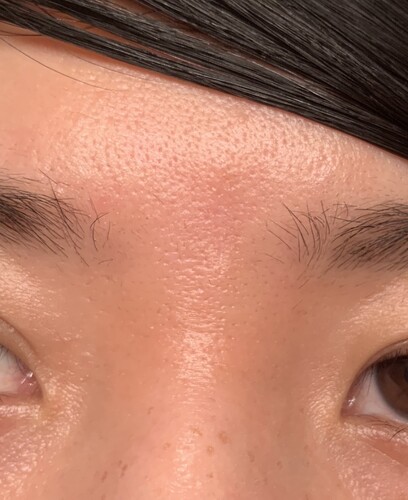 ドッグイヤーと縫合線が気になります 輪郭 顎の整形 額の整形 の治療への不安 痛み 失敗 副作用