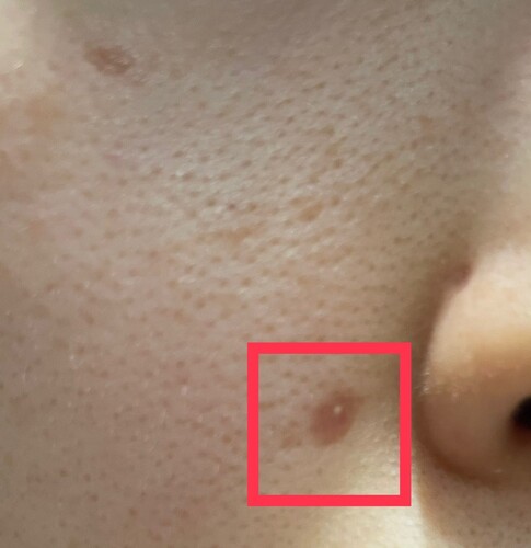 1ヶ月前に行ったほくろ除去痕の真ん中に白い点がある ほくろ除去 あざ治療 イボ治療の治療への不安 痛み 失敗 副作用