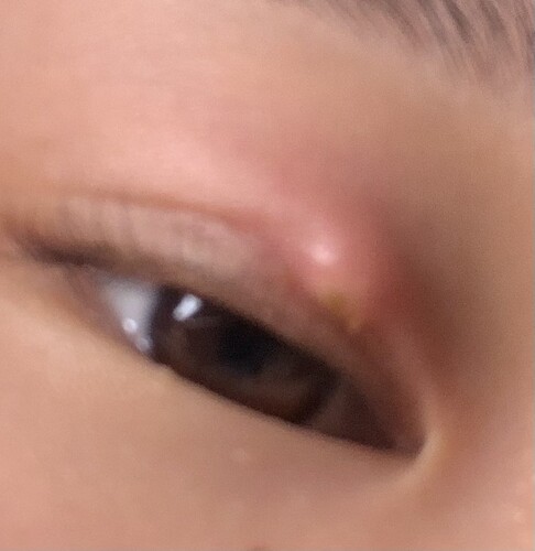 埋没後の瞼の化膿 目 二重整形 二重埋没法 の治療への不安 痛み 失敗 副作用