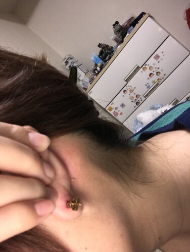 シフト コーン 散文 ピアス 埋まる 病院 料金 Akrimax Pap Com