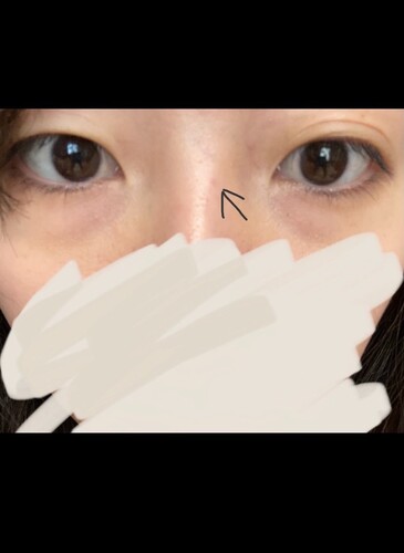 鼻筋に薄い紫色の丸いなにかが見えるようになりました。 鼻の整形の
