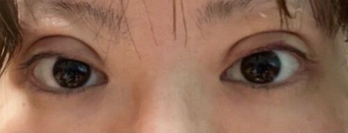 埋没後の腫れと目の開きが不安です 目 二重整形 二重埋没法 の治療への不安 痛み 失敗 副作用