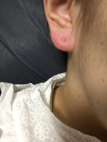 ピアスが塞がってしまった場合 どうすればいいですか ピアス穴あけ 耳のピアス の治療への不安 痛み 失敗 副作用