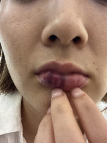 唇ヒアルロン酸 全体的な痛み腫れ 黒く血豆ができてます 口元 唇の整形 ヒアルロン酸注入 口元 唇 の治療への不安 痛み 失敗 副作用