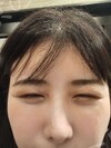 施術後の状態