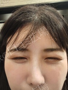 【おすすめ！】　涙袋ヒアルロン酸（0.1㏄）の治療結果の症例写真