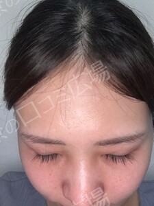ジェネシスの治療直後の症例写真