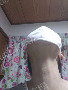治療直後の症例写真