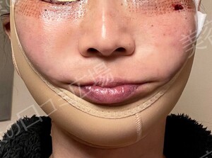 治療直後の症例写真