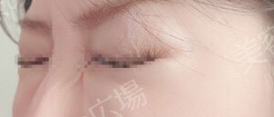 治療直後の症例写真