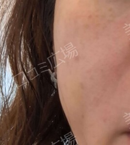 治療前の症例写真