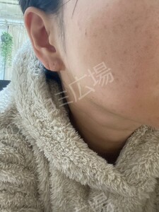 治療直後の症例写真