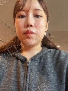 ボトックス韓国製200単位｜エラ・肩・ワキ・ふくらはぎからの治療直後の症例写真