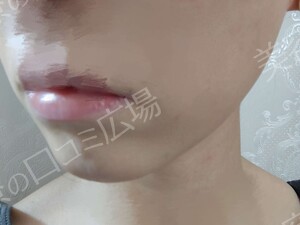 治療結果の症例写真