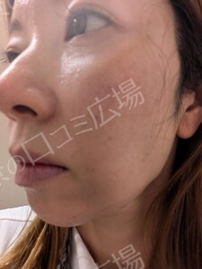 治療直後の症例写真