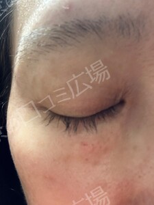 治療直後の症例写真