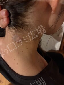 治療直後の症例写真