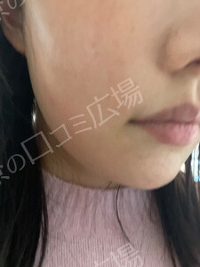 治療直後の症例写真