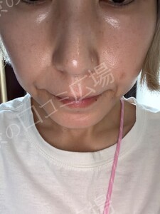 治療前の症例写真