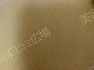 口コミ広場会員様限定！全身脱毛5回コース 146,300円の治療結果の症例写真
