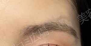 PRISM Beauty Clinicのしわ・たるみ整形(注入、糸、フェイスリフト)の症例写真[ビフォー]